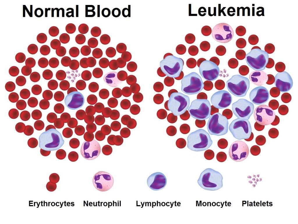 Trattamento della leucemia mieloide cronica