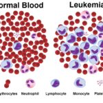 Trattamento della leucemia mieloide cronica
