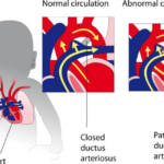 Chiusura del dotto arterioso