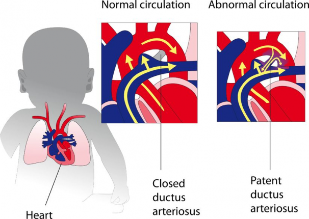Chiusura del dotto arterioso